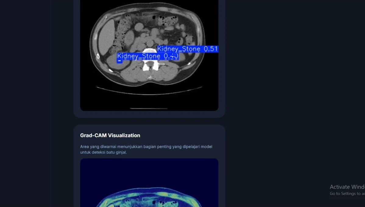 Kidney Stone - AI Detection Batu Ginjal - 2